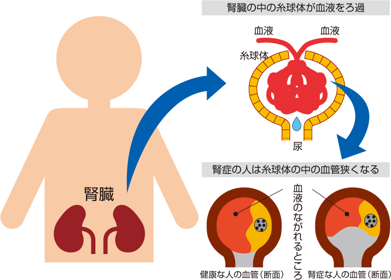 糖尿病網膜症